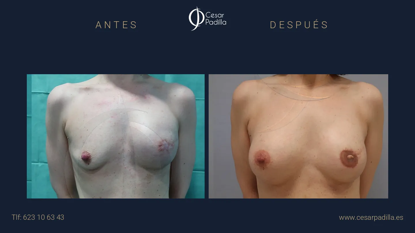 Antes y después de Reconstrucción mamaria oncológica