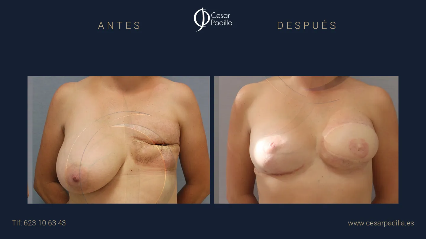 Antes y después de Reconstrucción mamaria oncológica