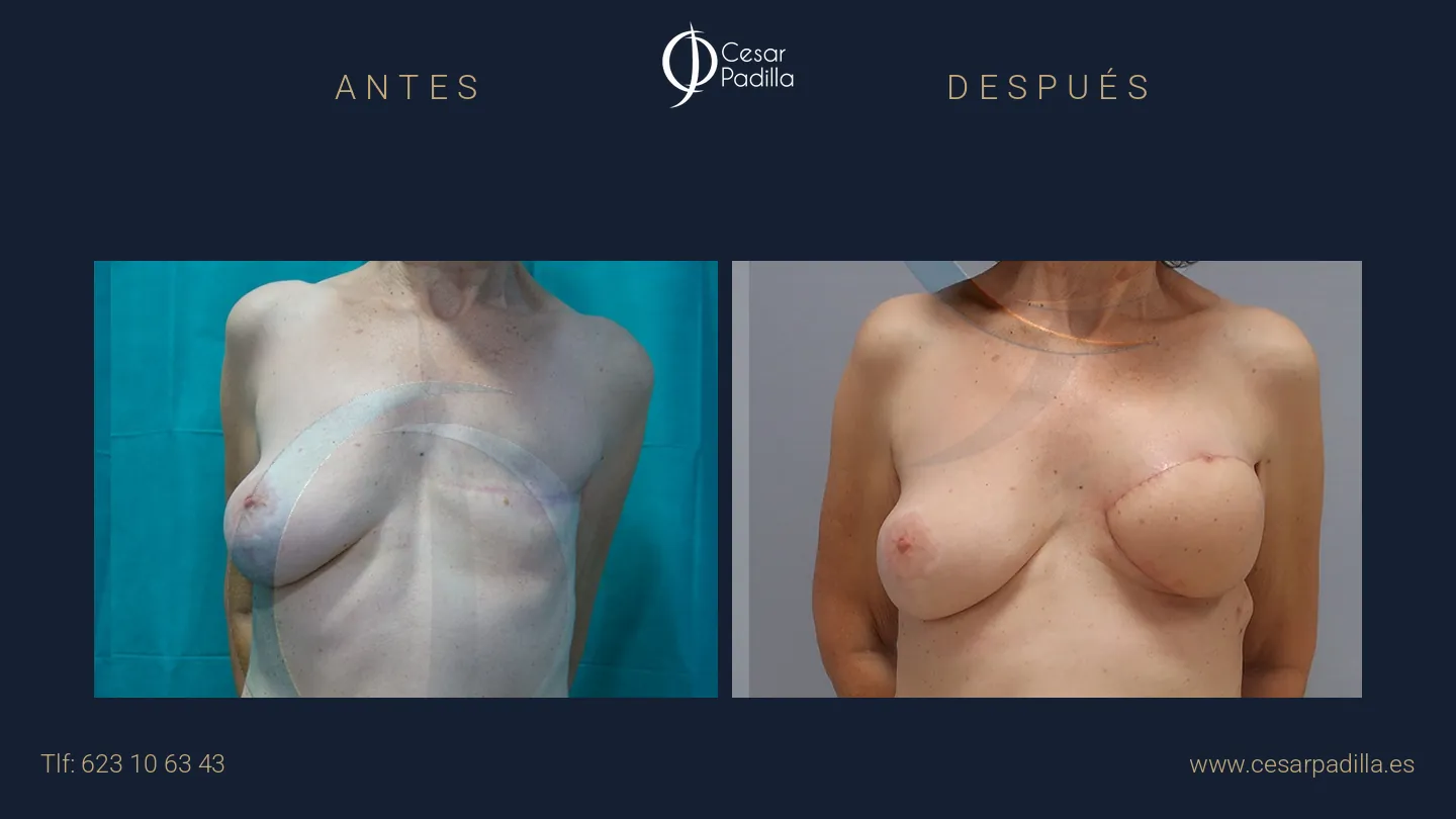 Antes y después de Reconstrucción mamaria oncológica