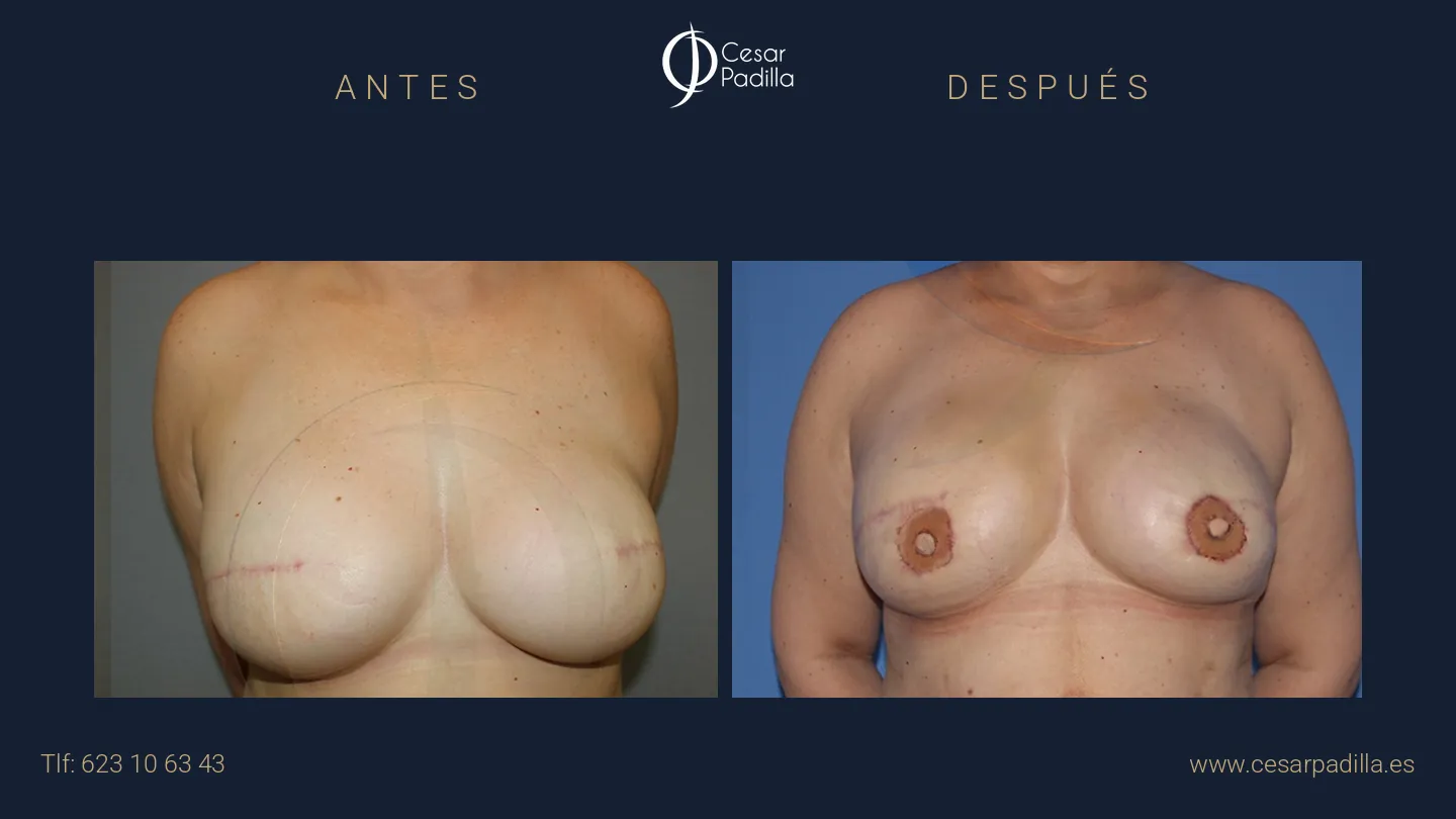 Antes y después de Reconstrucción mamaria oncológica