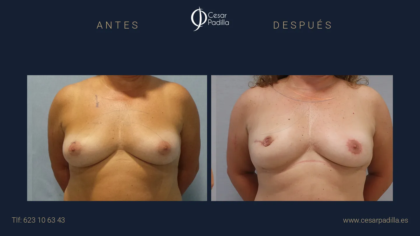 Antes y después de Reconstrucción mamaria oncológica