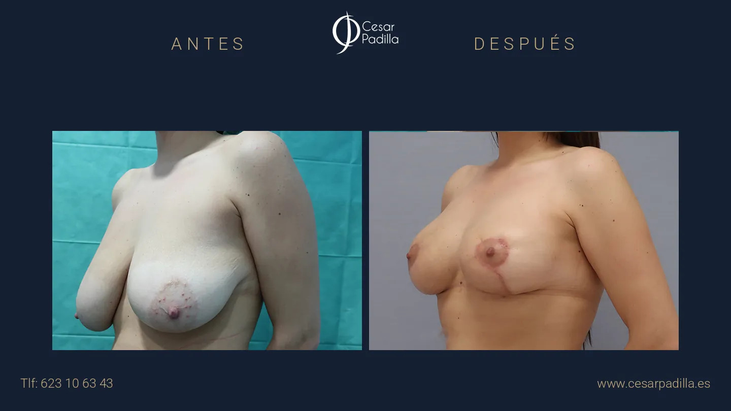 Antes y después de Reducción de pecho