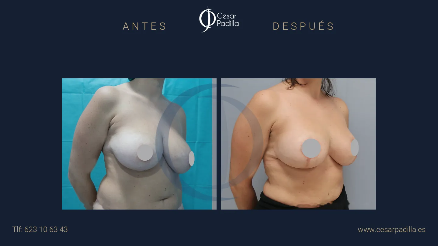 Antes y después de reducción de pecho, caso 10