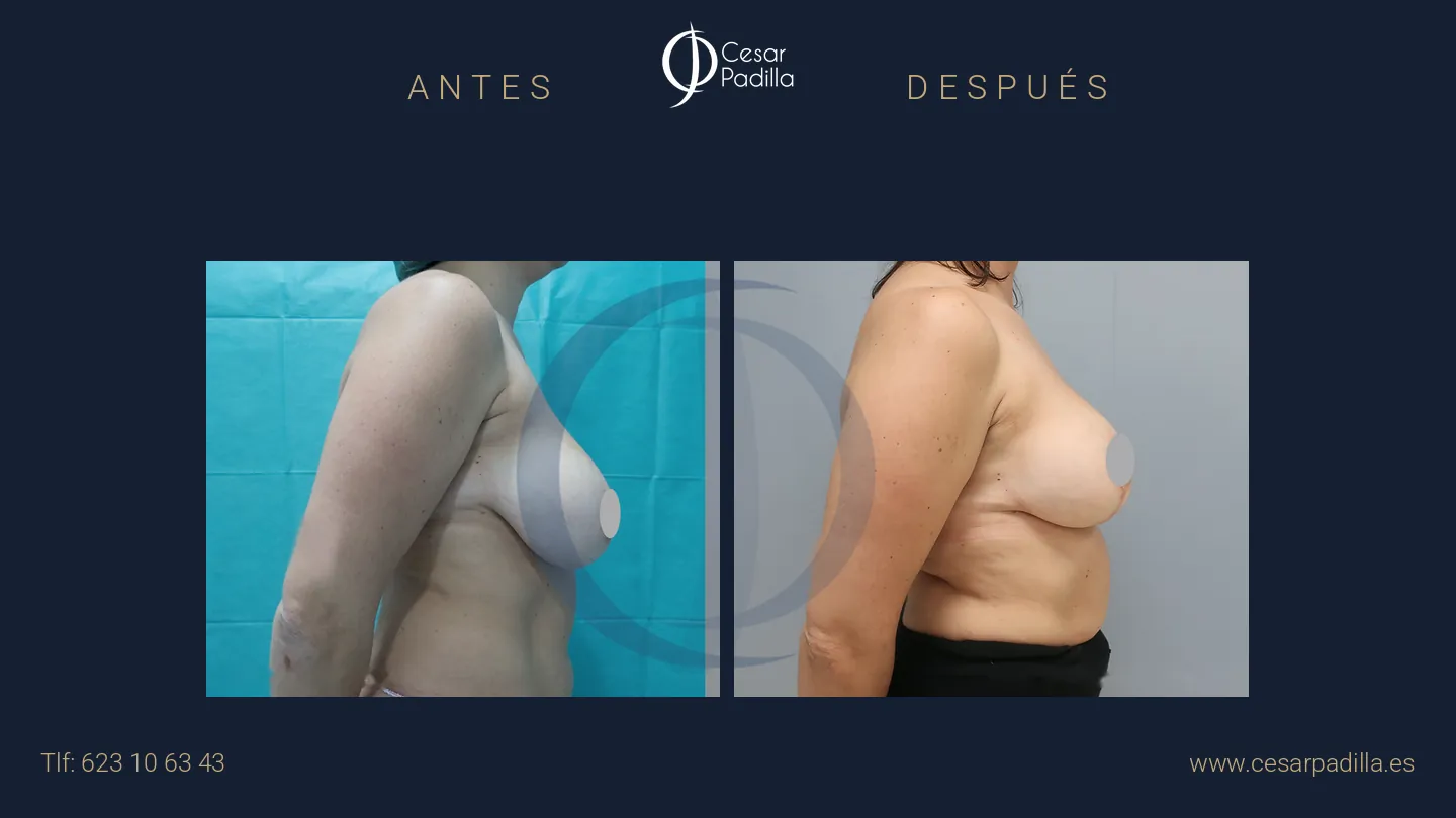 Antes y después de reducción de pecho, caso 11
