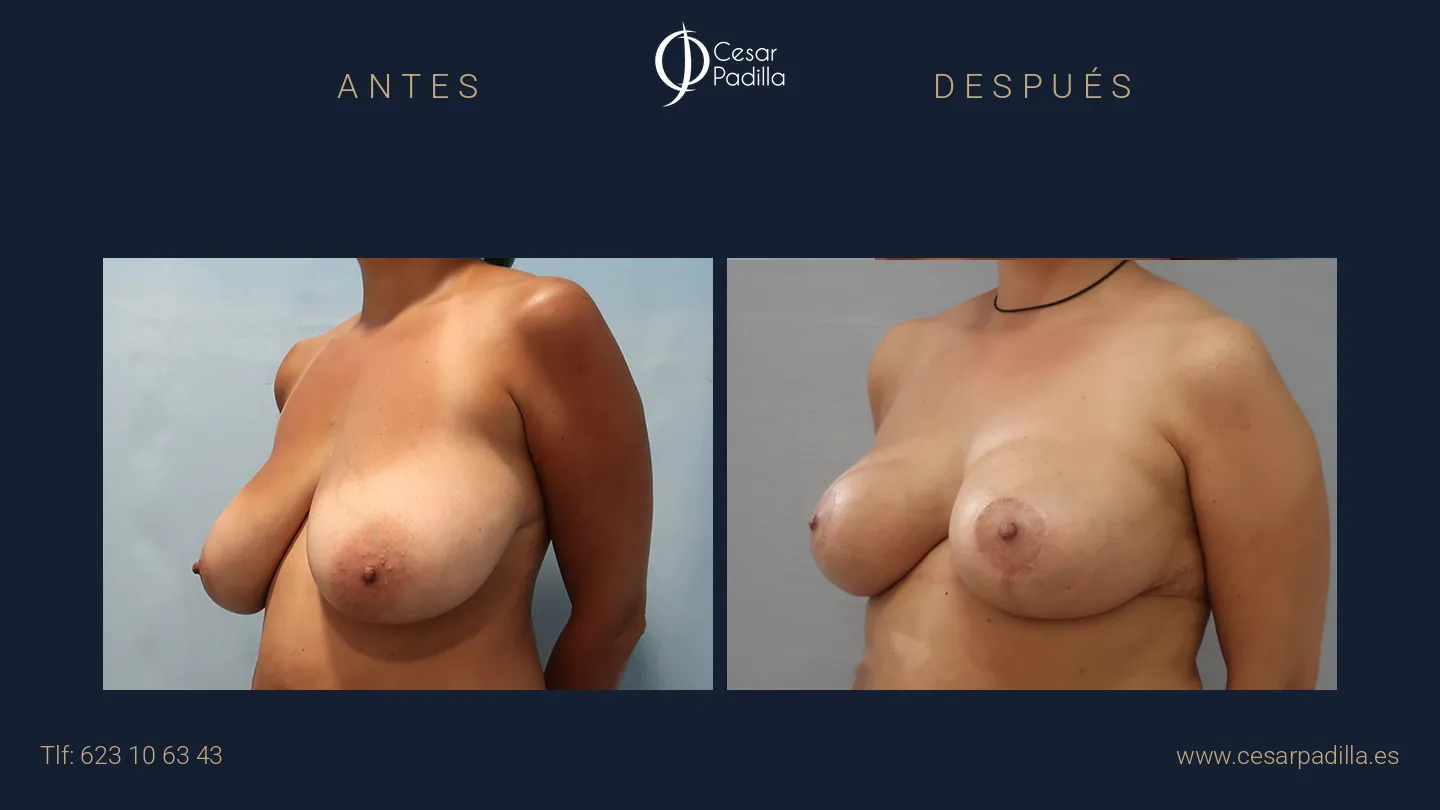 Antes y después de Reducción de pecho