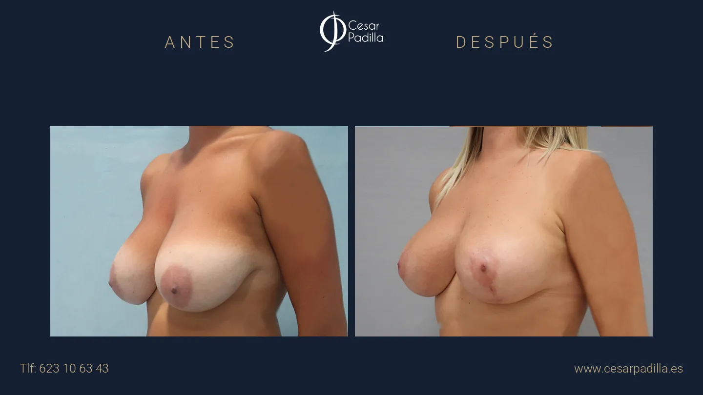 Antes y después de Reducción de pecho