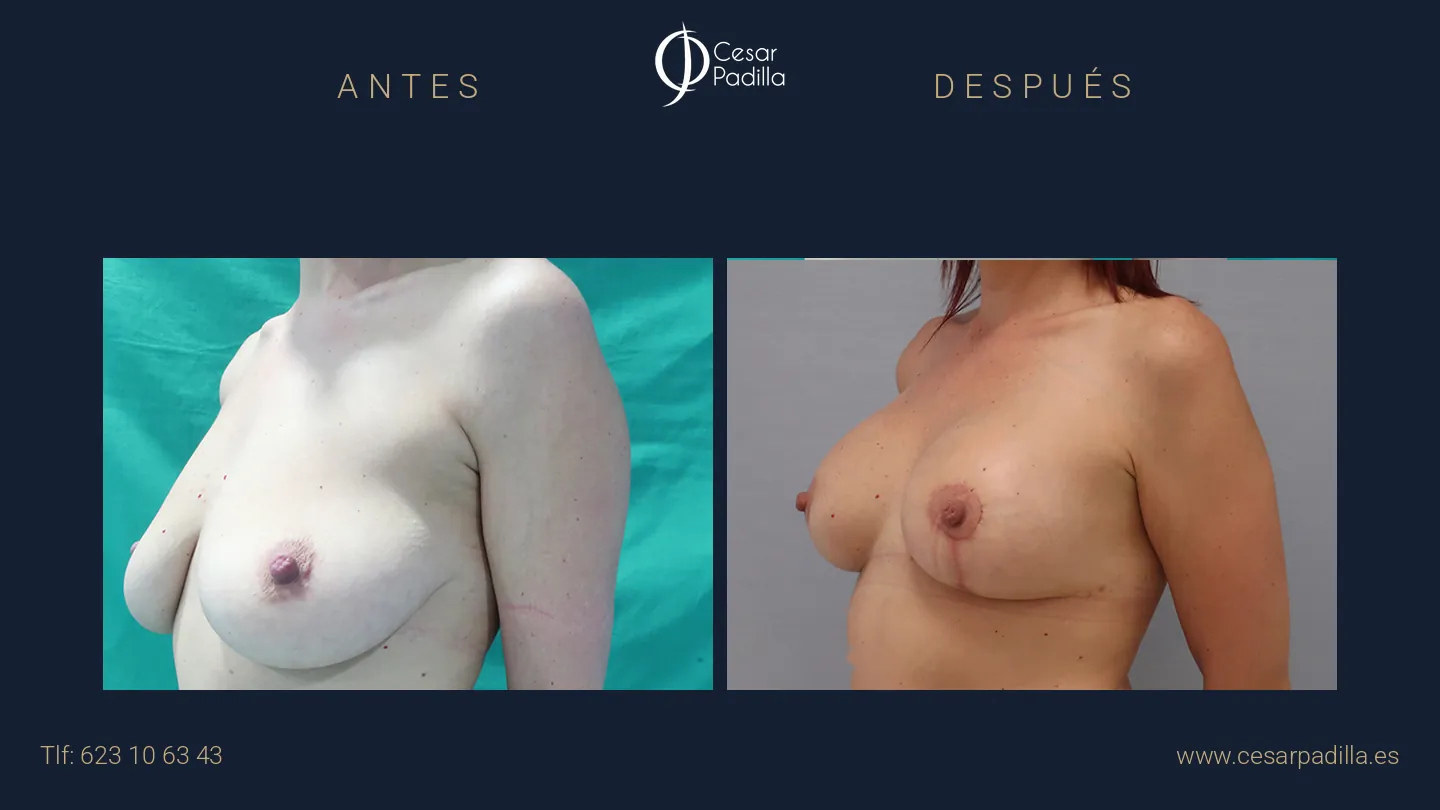 Antes y después de Reducción de pecho