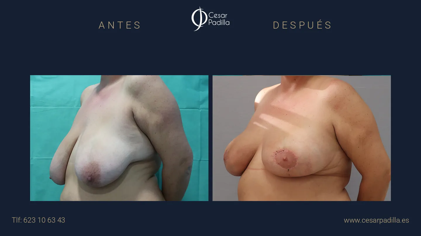 Antes y después de Reducción de pecho