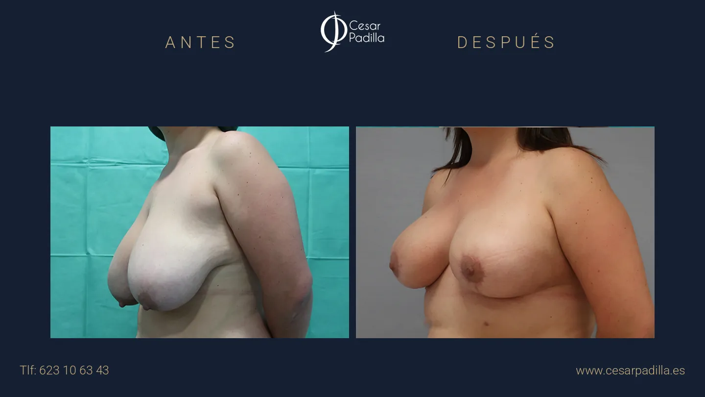 Antes y después de Reducción de pecho