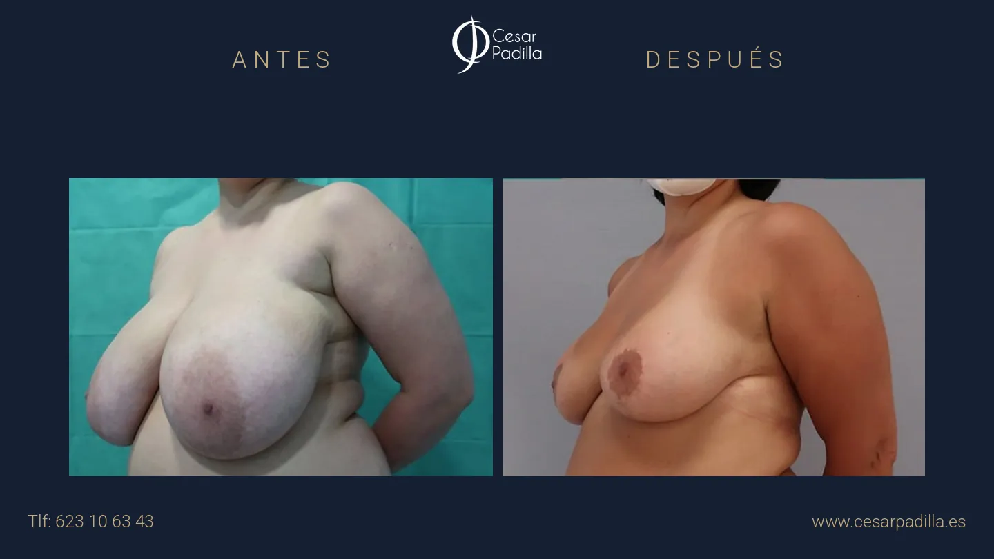 Antes y después de Reducción de pecho