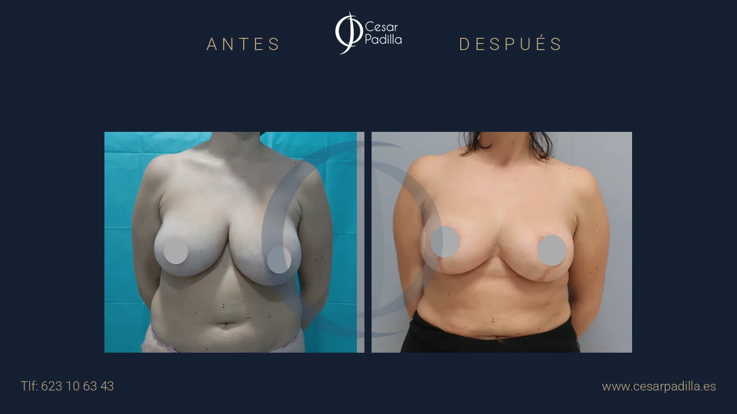 Antes y después de Reducción de pecho