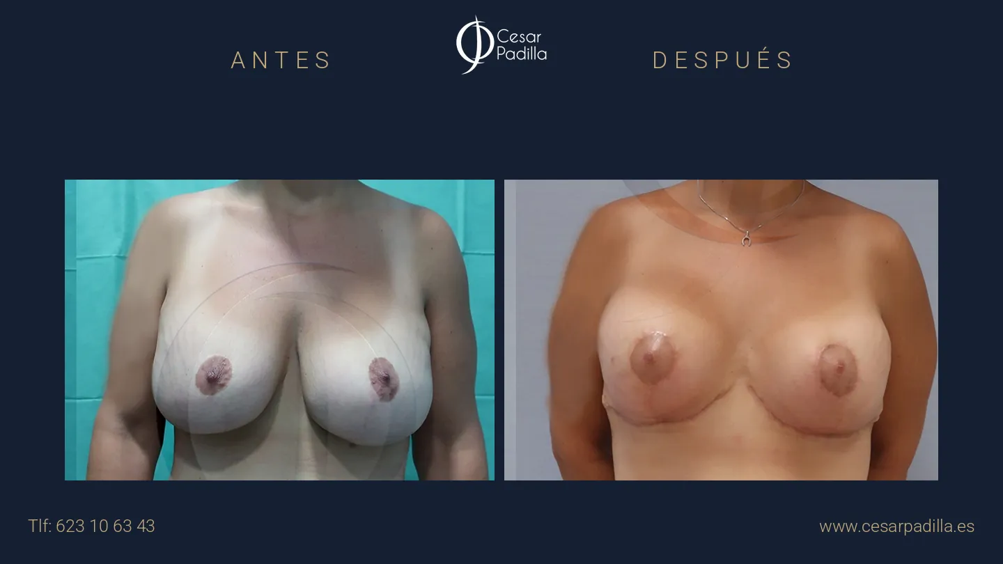 Antes y después de cirugía mamaria secundaria, caso 10