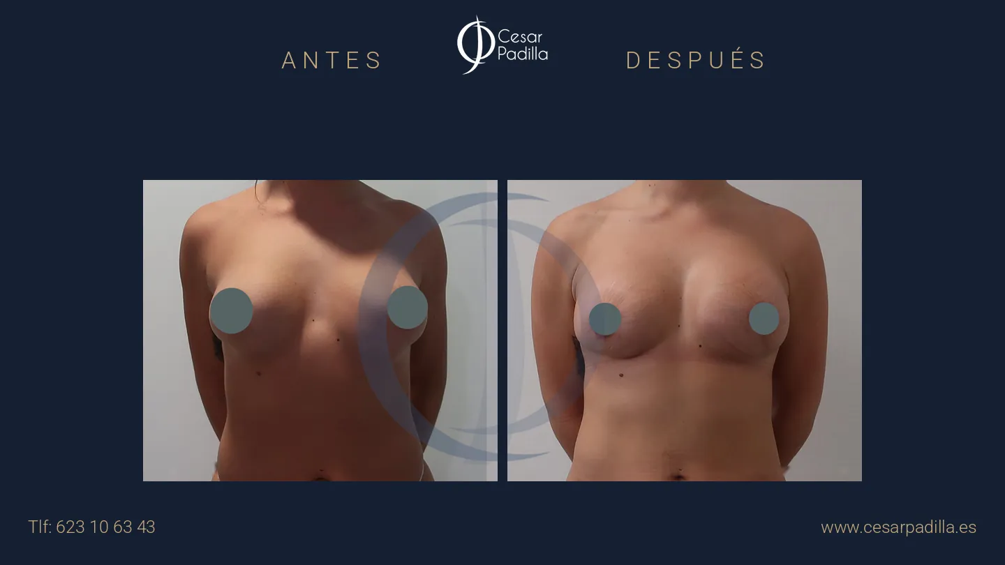 Antes y después de cirugía mamaria secundaria, caso 11