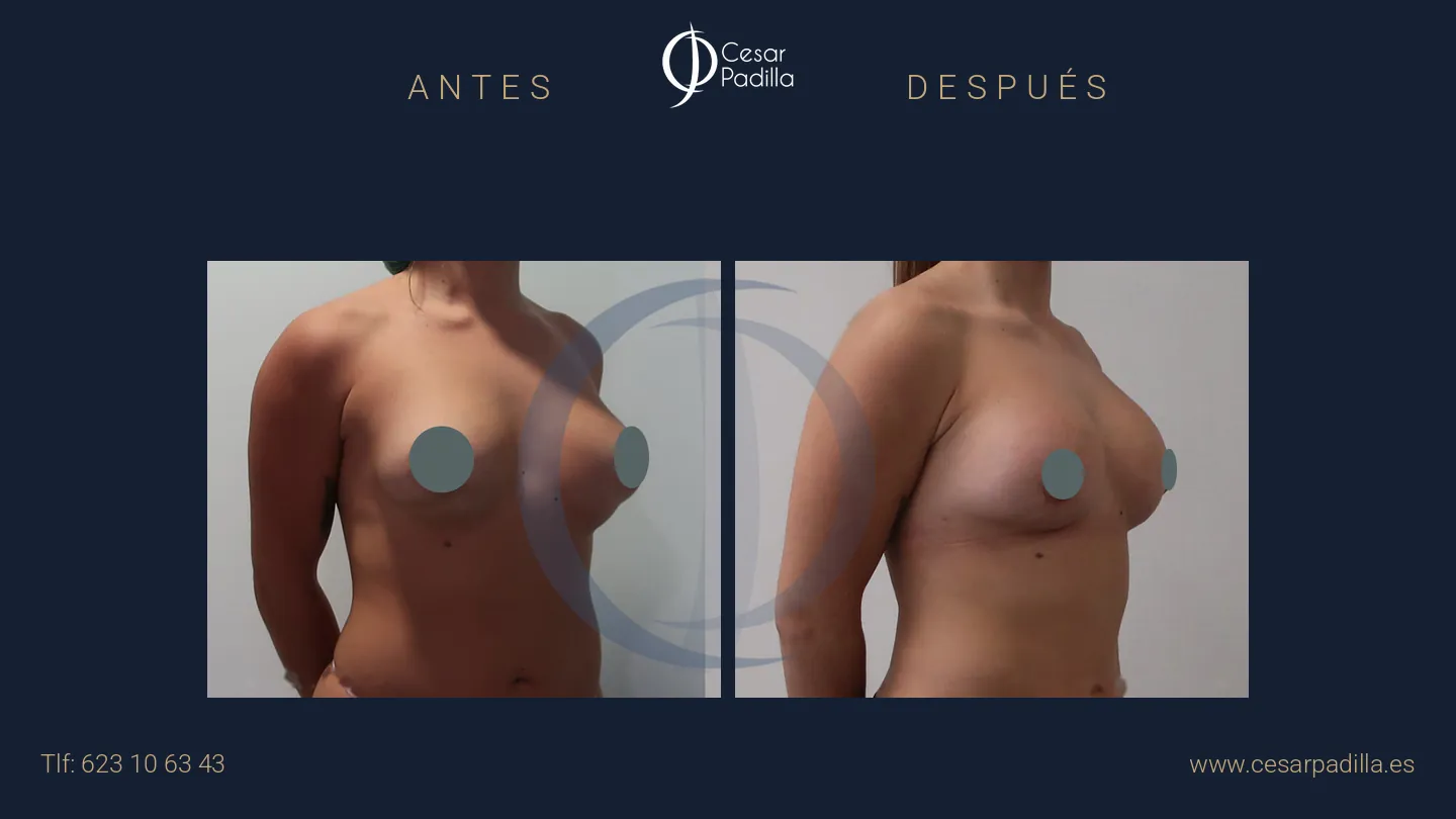 Antes y después de cirugía mamaria secundaria, caso 12