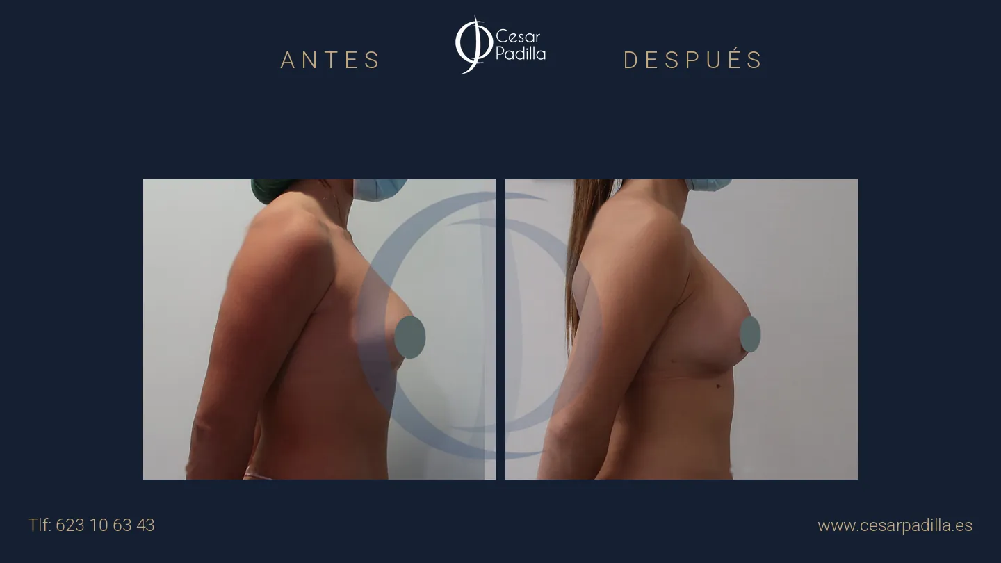 Antes y después de cirugía mamaria secundaria, caso 13