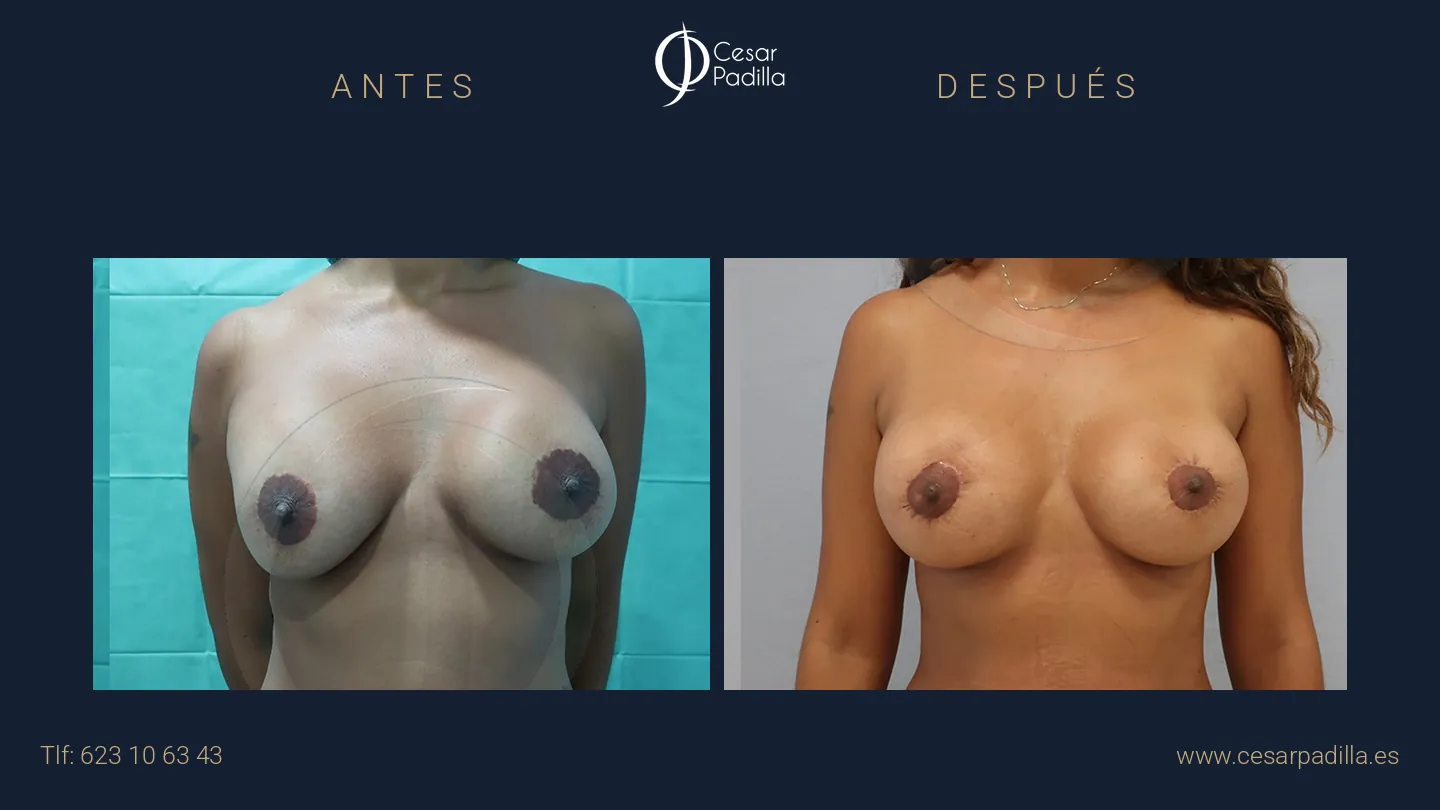 Cirugia Mamaria Secundaria en Málaga | Dr. César Padilla