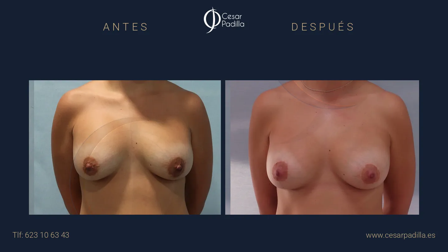 Antes y después de Cirugía mamaria secundaria