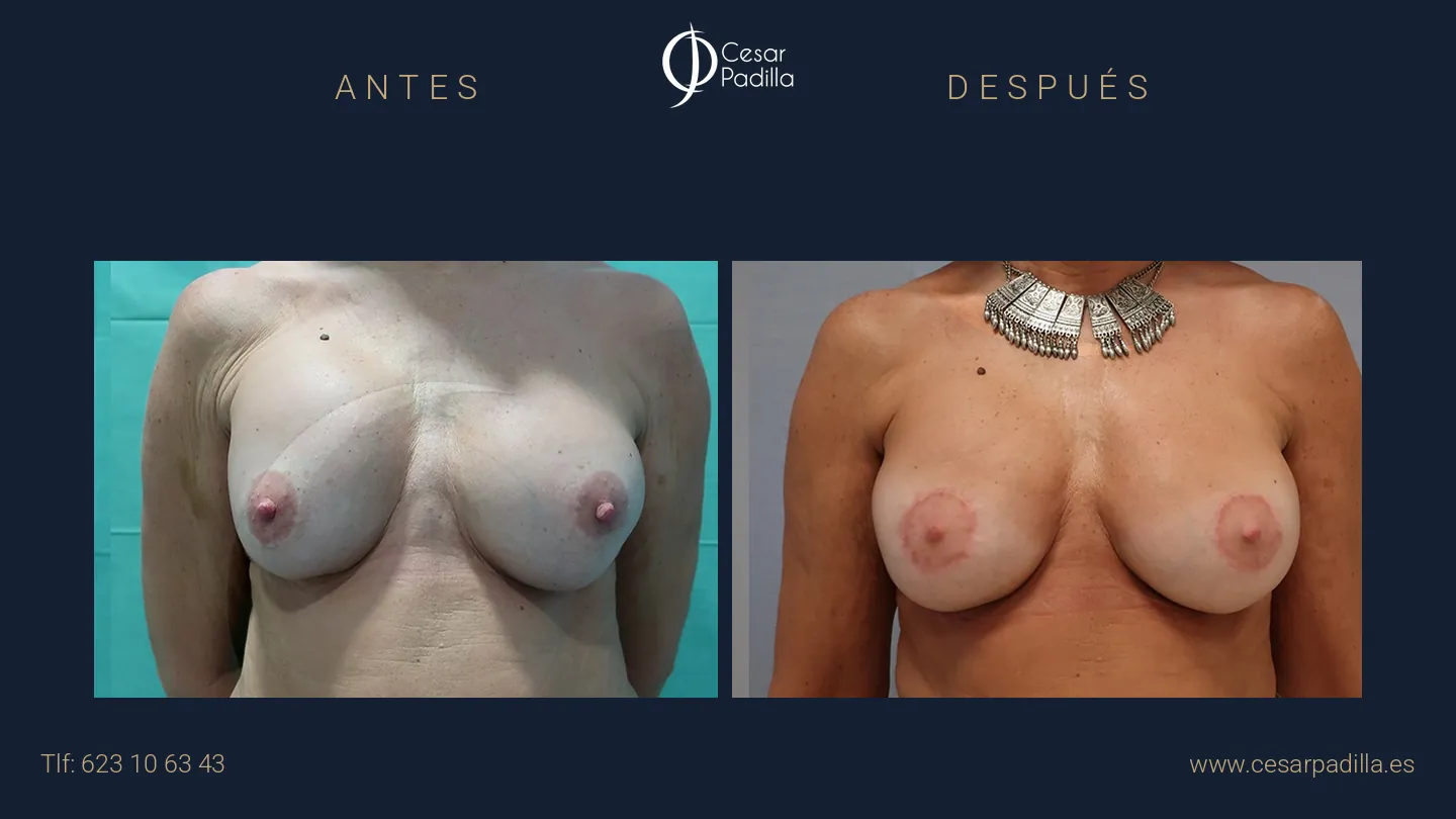 Antes y después de Cirugía mamaria secundaria