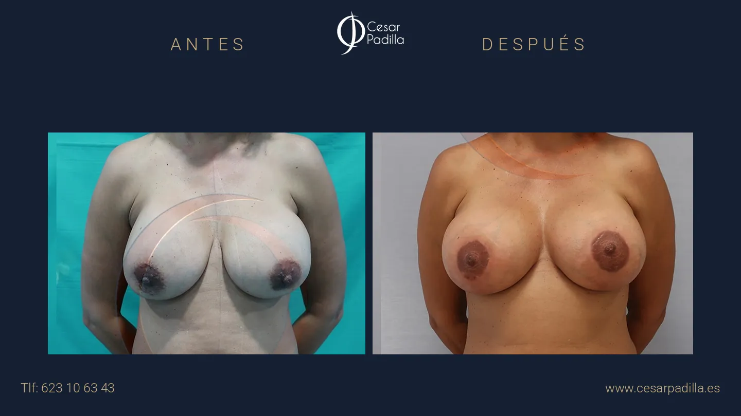 Antes y después de Cirugía mamaria secundaria