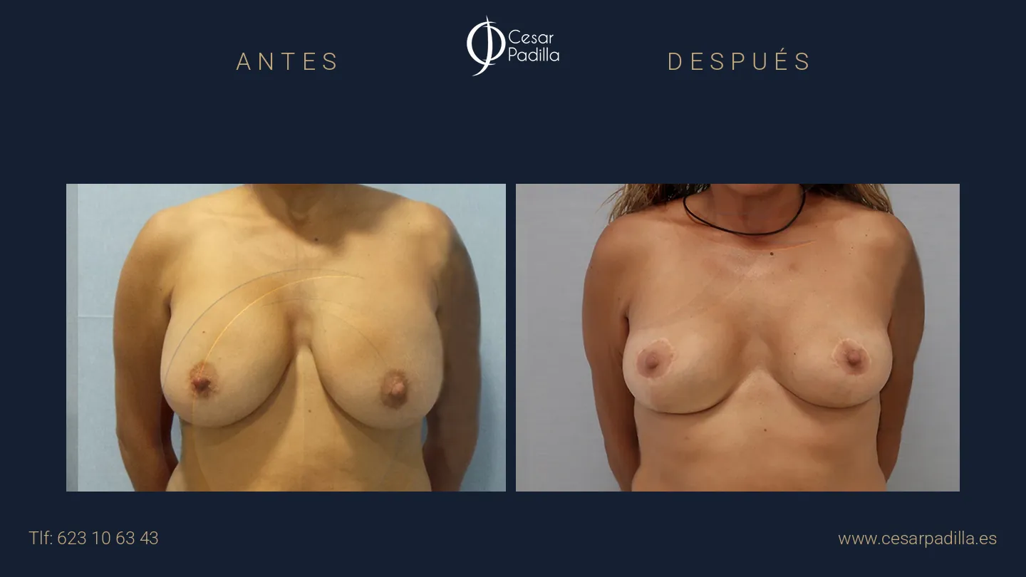 Antes y después de Cirugía mamaria secundaria