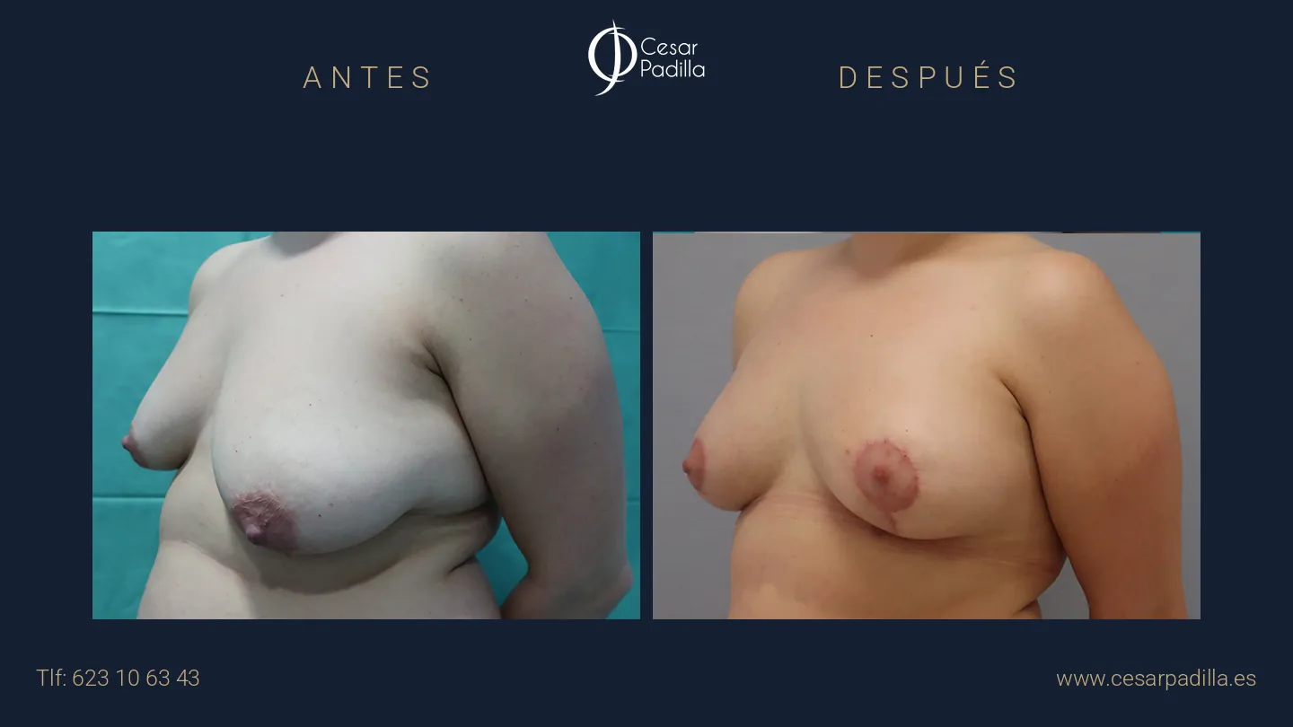 Antes y después de simetrización mamaria, caso 1