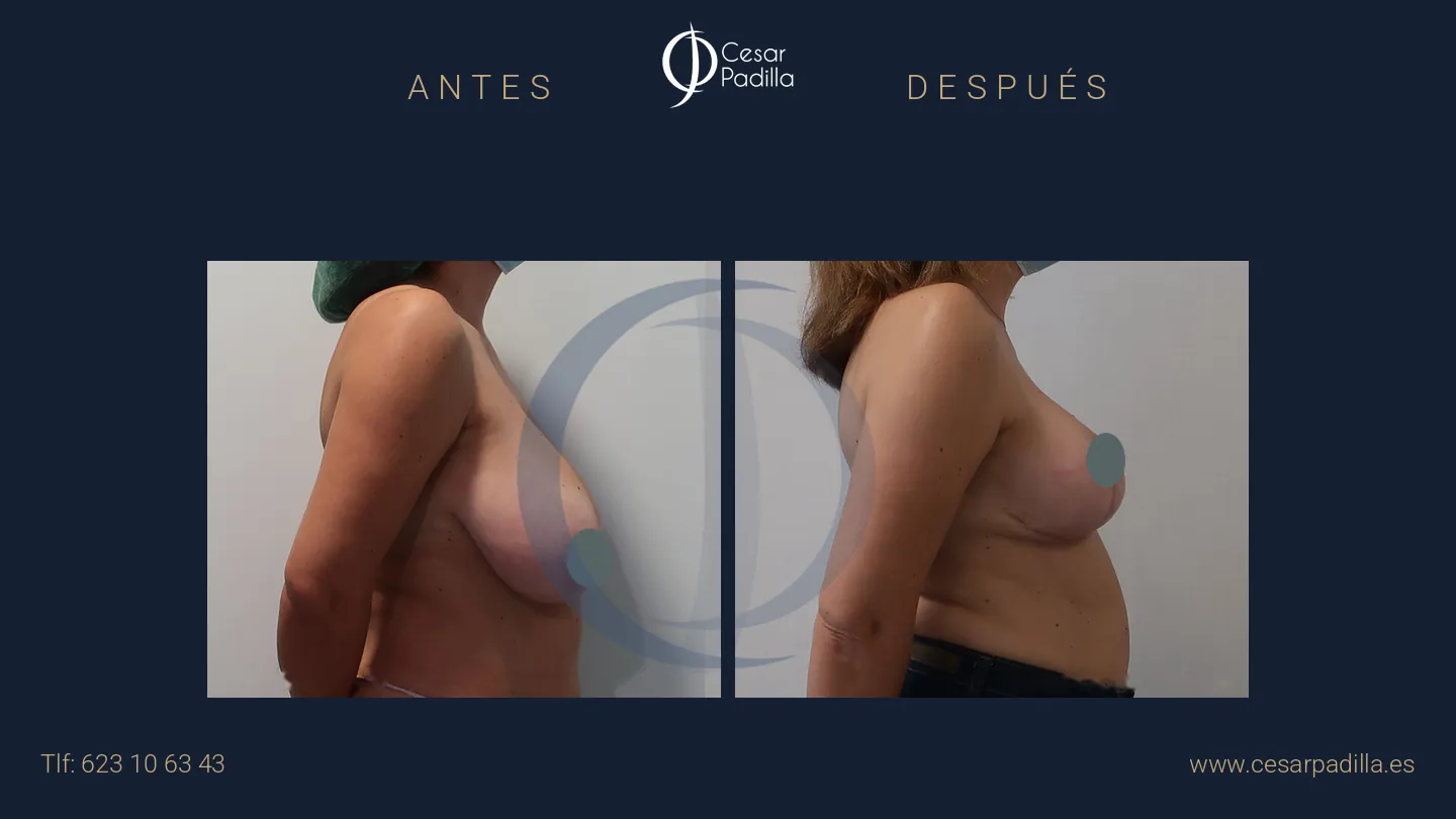 Antes y después de simetrización mamaria, caso 11