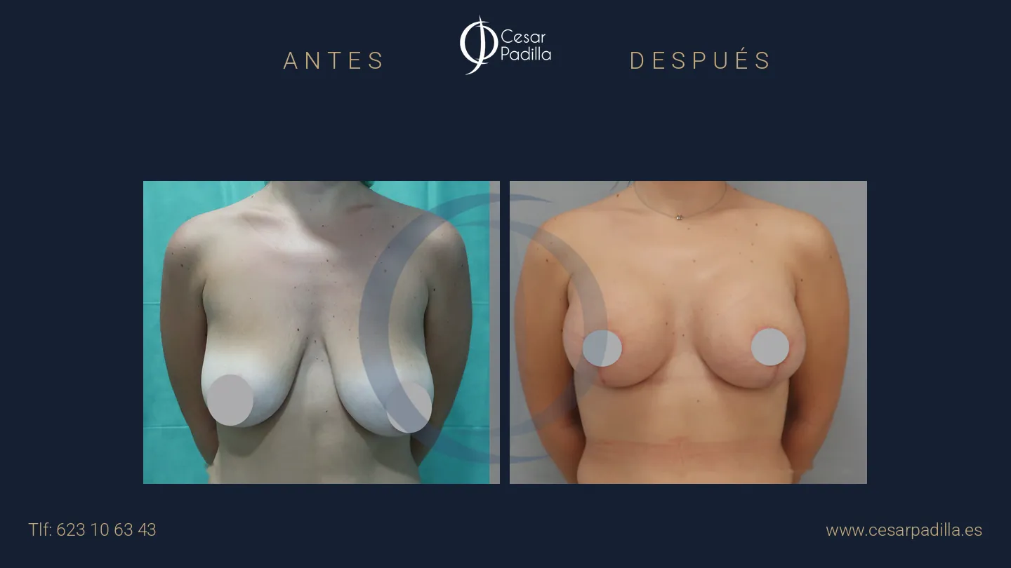 Antes y después de simetrización mamaria, caso 12