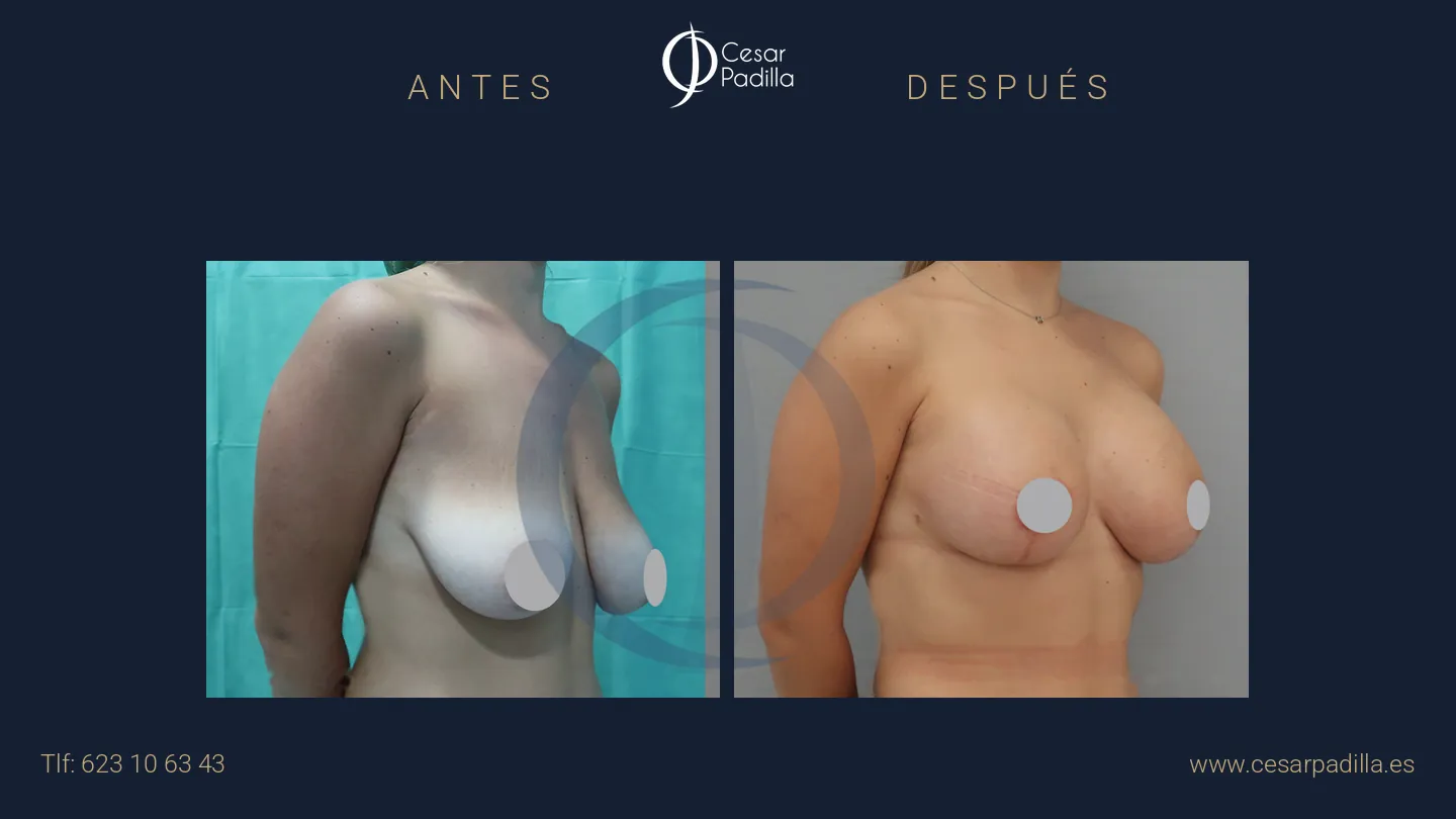 Antes y después de simetrización mamaria, caso 13