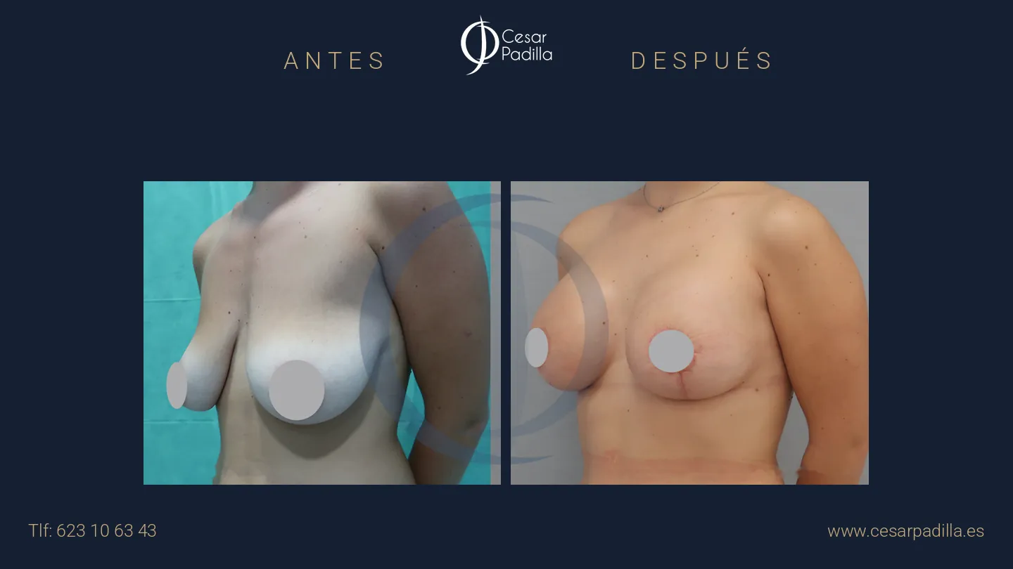 Antes y después de simetrización mamaria, caso 14