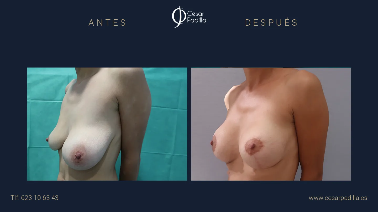 Antes y después de simetrización mamaria, caso 2