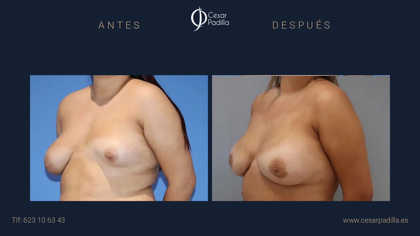 Antes y después de simetrización mamaria, caso 4