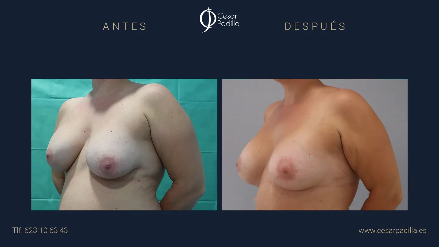 Antes y después de simetrización mamaria, caso 5