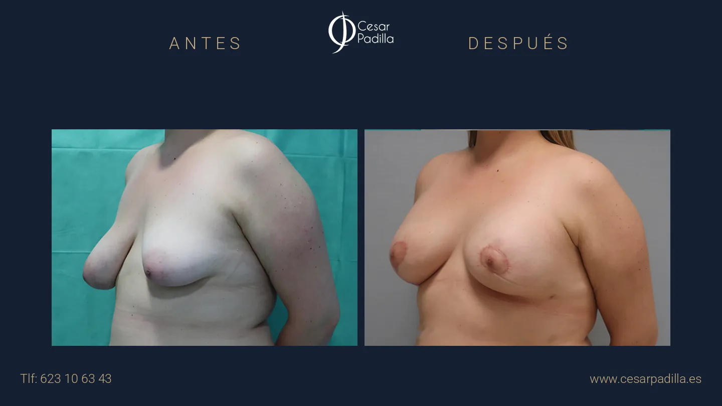 Antes y después de simetrización mamaria, caso 6