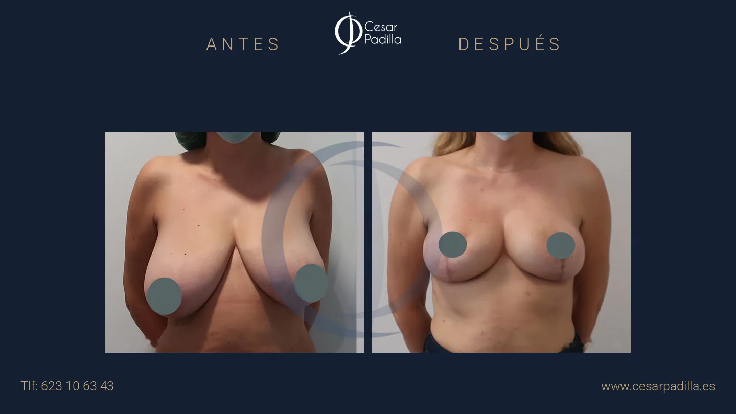 Antes y después de simetrización mamaria, caso 9