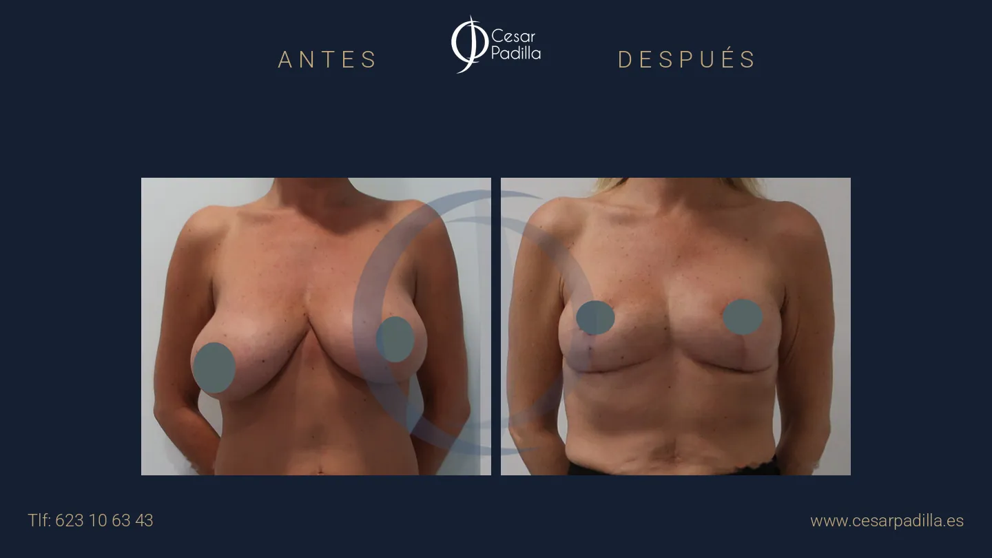 Antes y después de Mastopexia sin implantes