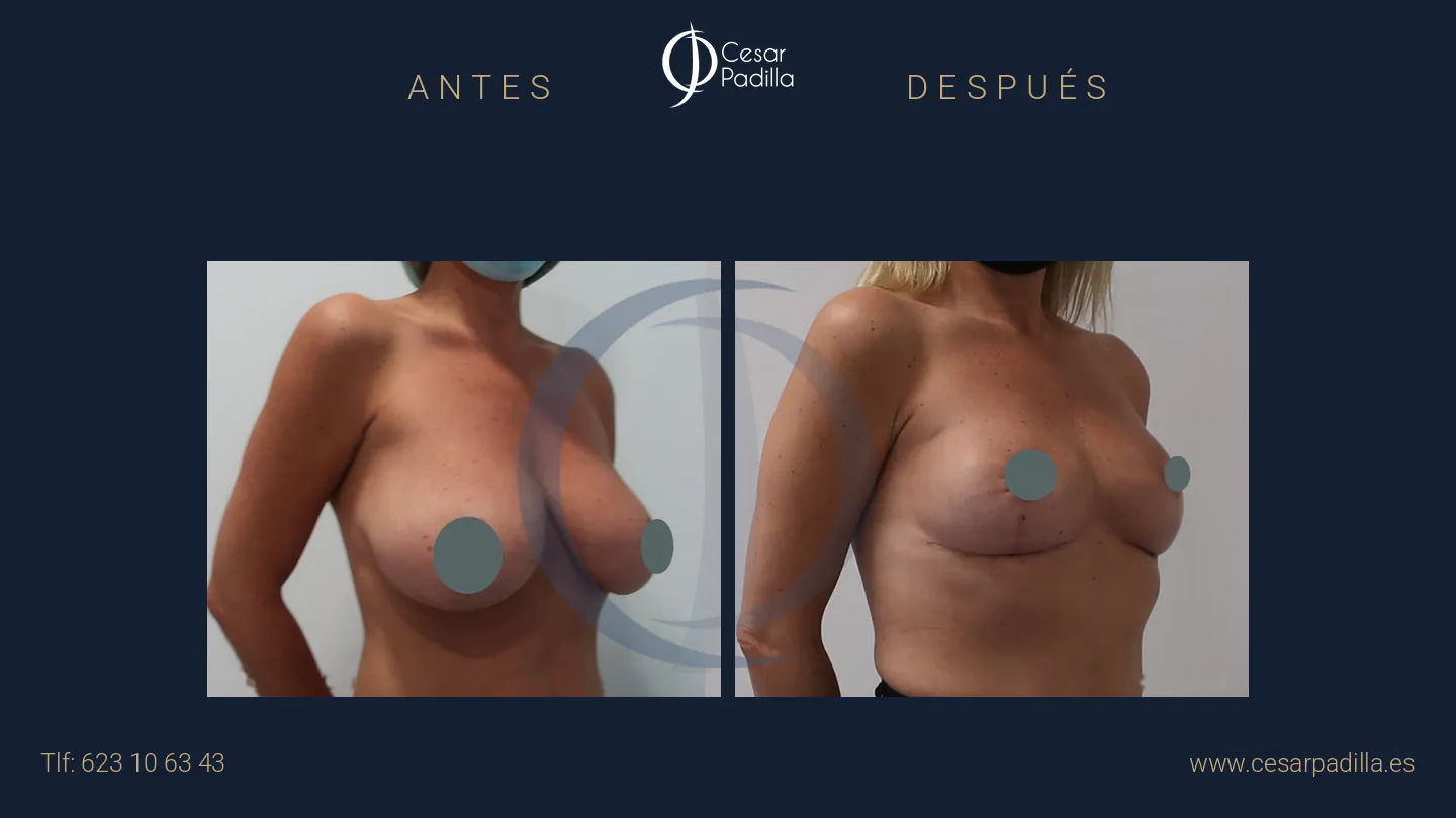 Antes y después de Mastopexia sin implantes