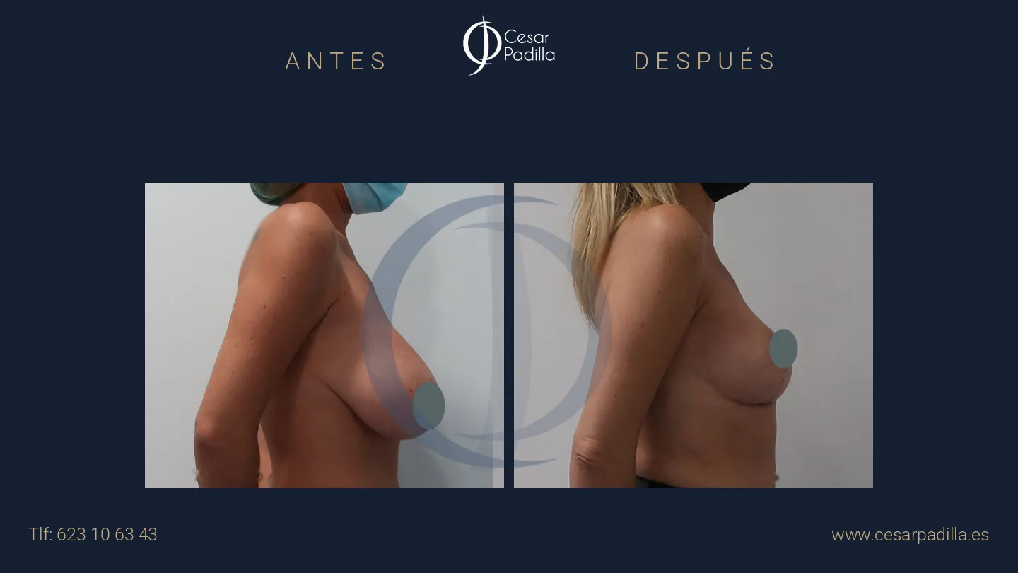 Antes y después de Mastopexia sin implantes