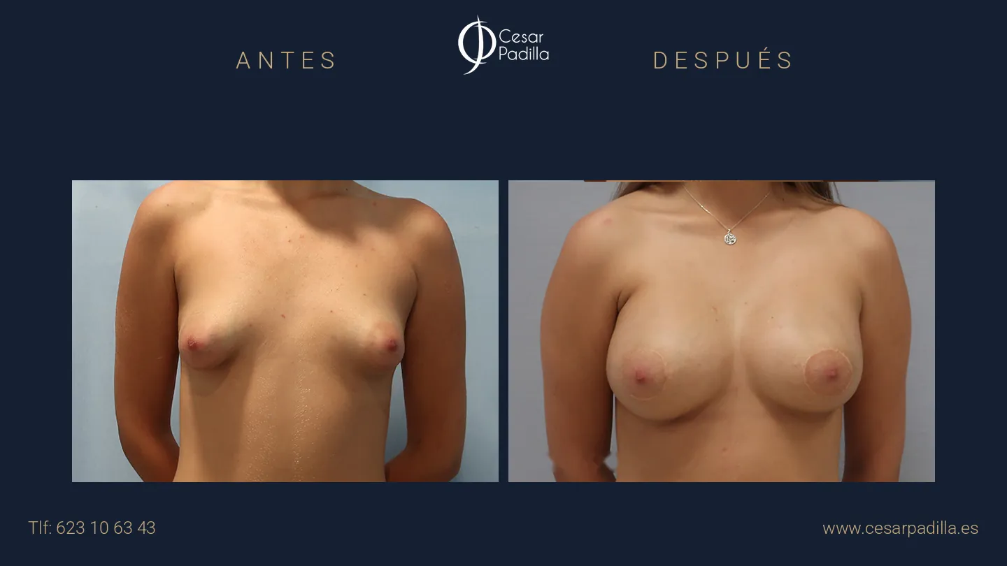 Antes y después de mama tuberosa, caso 1