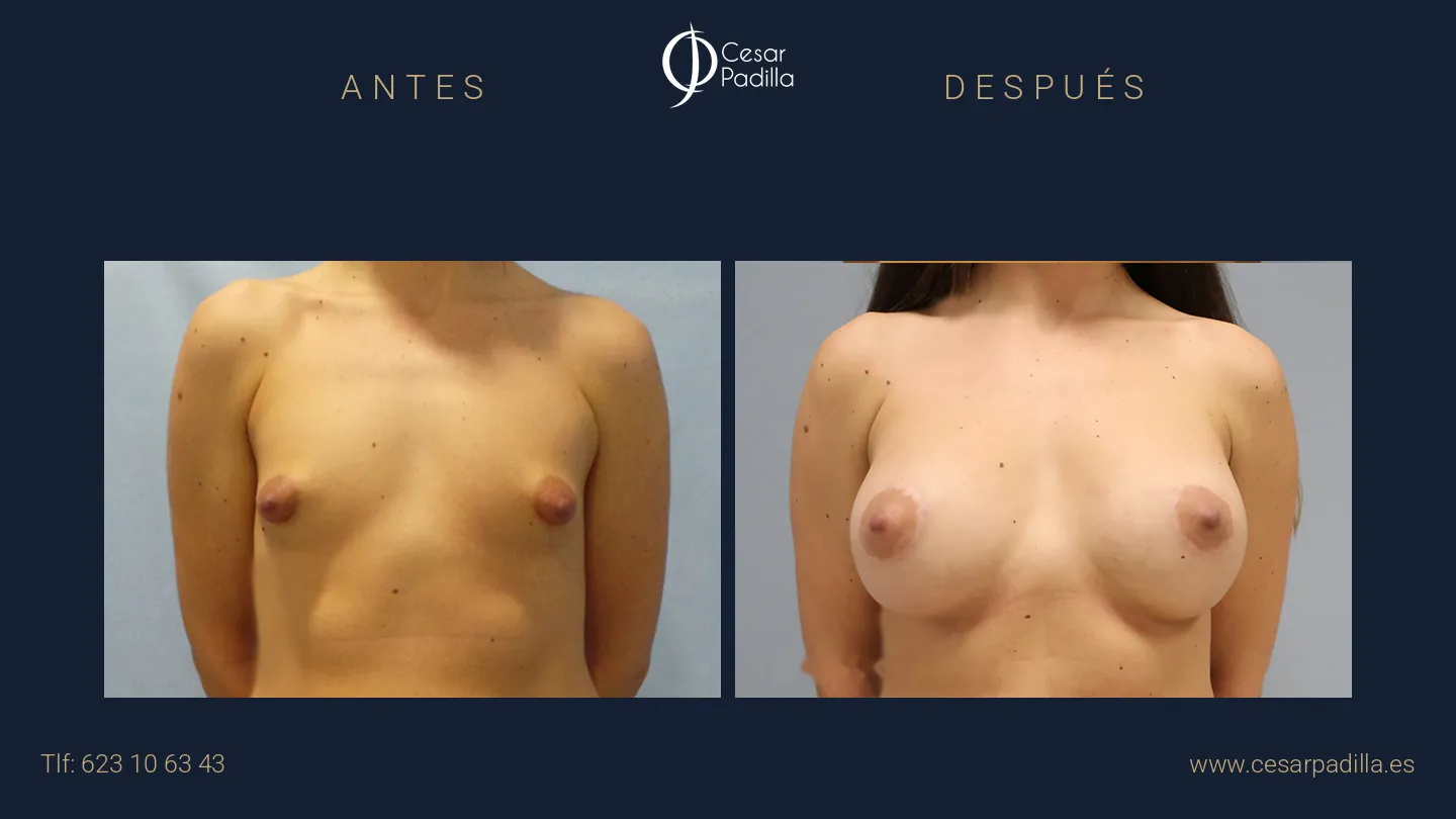 Antes y después de mama tuberosa, caso 2