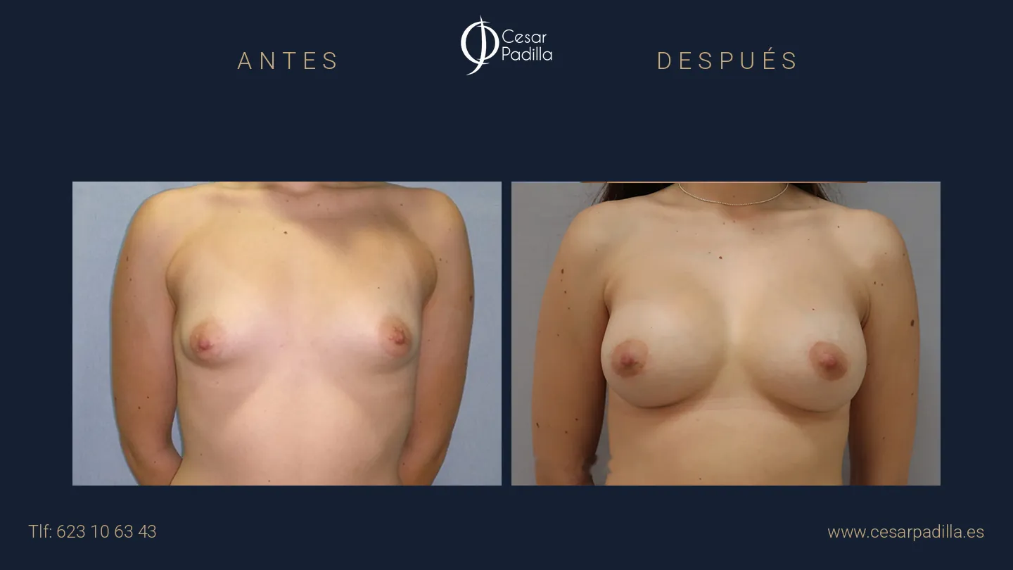 Antes y después de mama tuberosa, caso 3