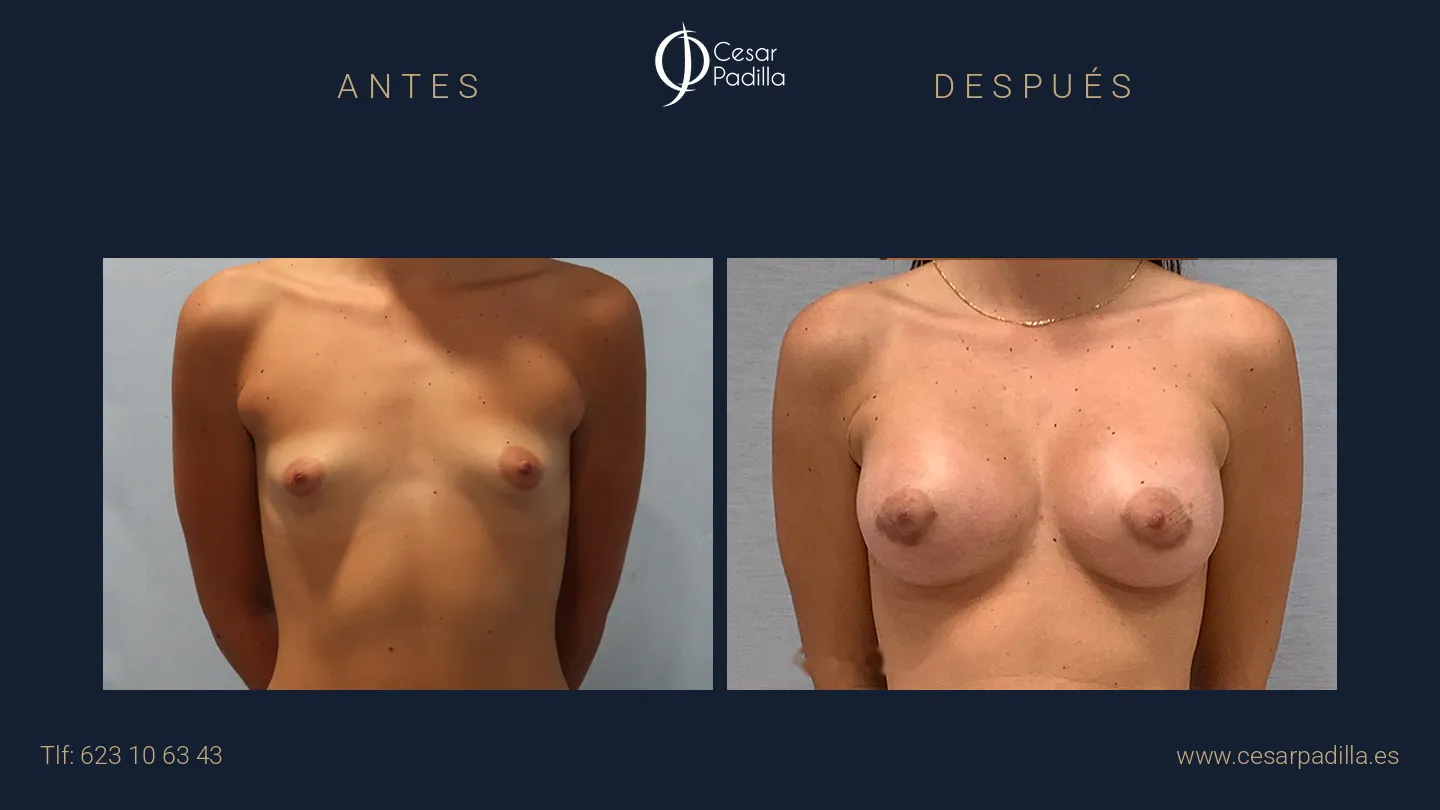 Antes y después de mama tuberosa, caso 4
