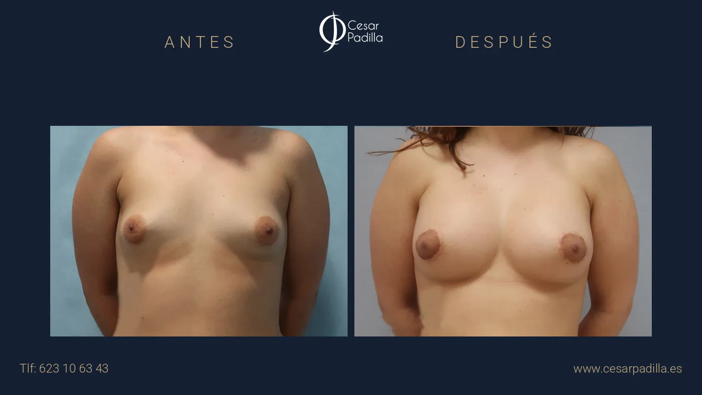 Antes y después de mama tuberosa, caso 5