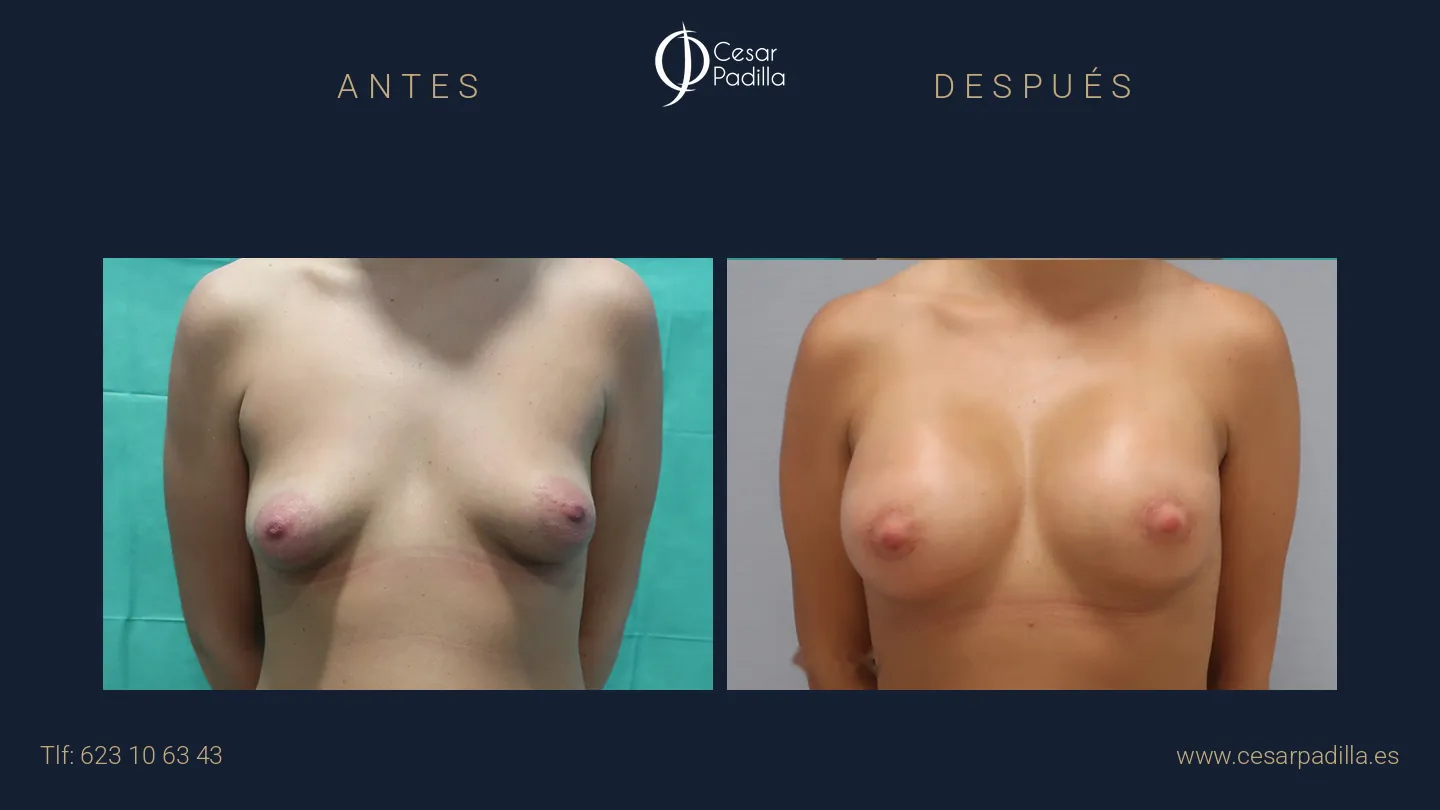 Antes y después de mama tuberosa, caso 6