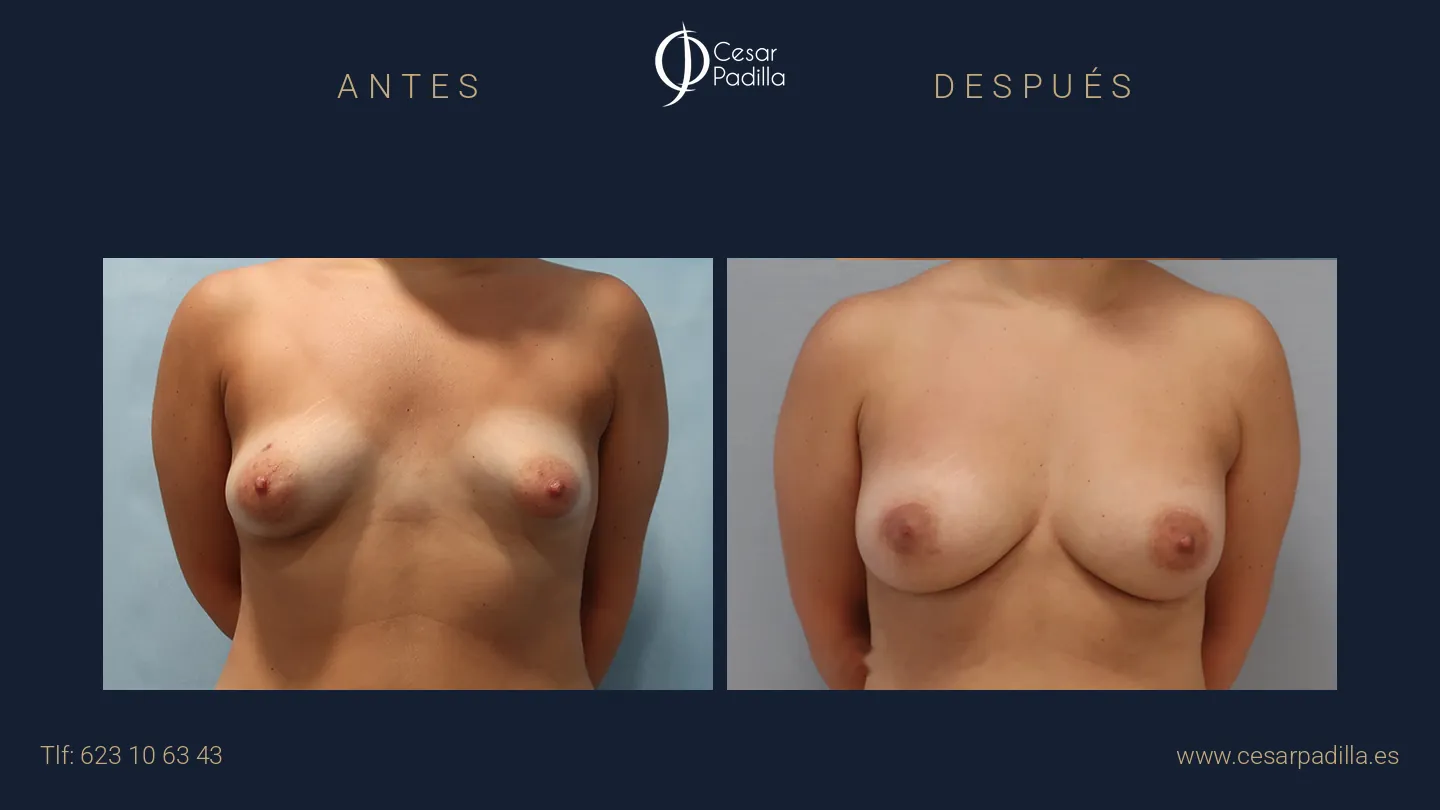 Antes y después de mama tuberosa, caso 7