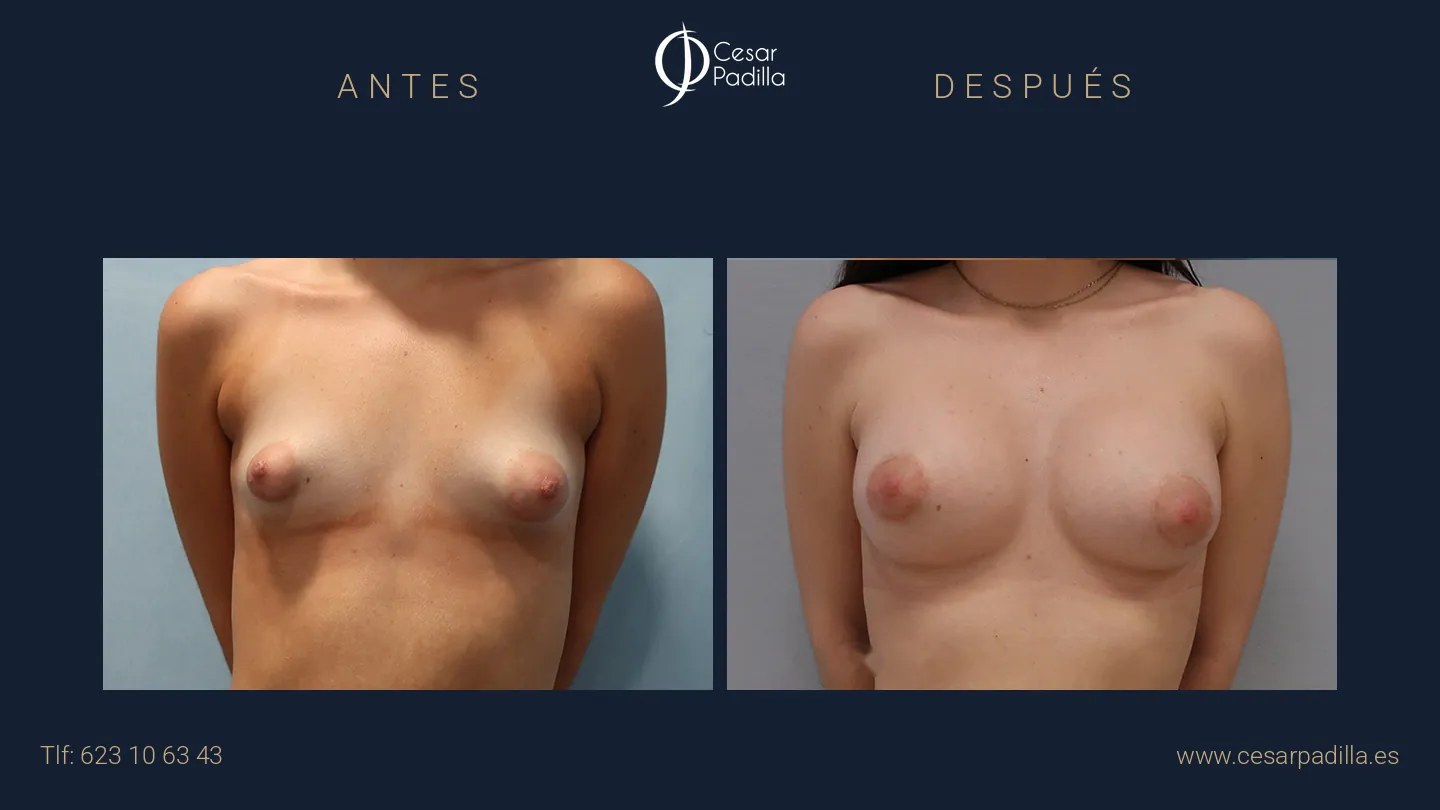 Antes y después de mama tuberosa, caso 8