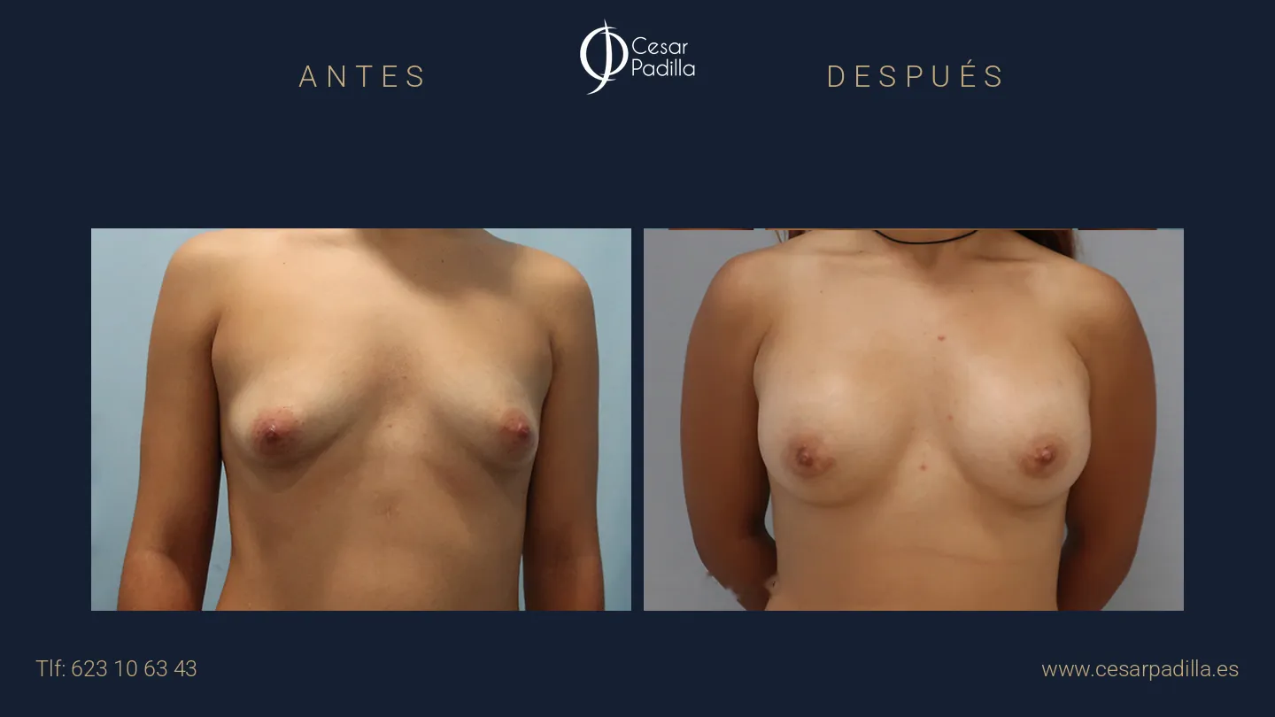 Antes y después de mama tuberosa, caso 9